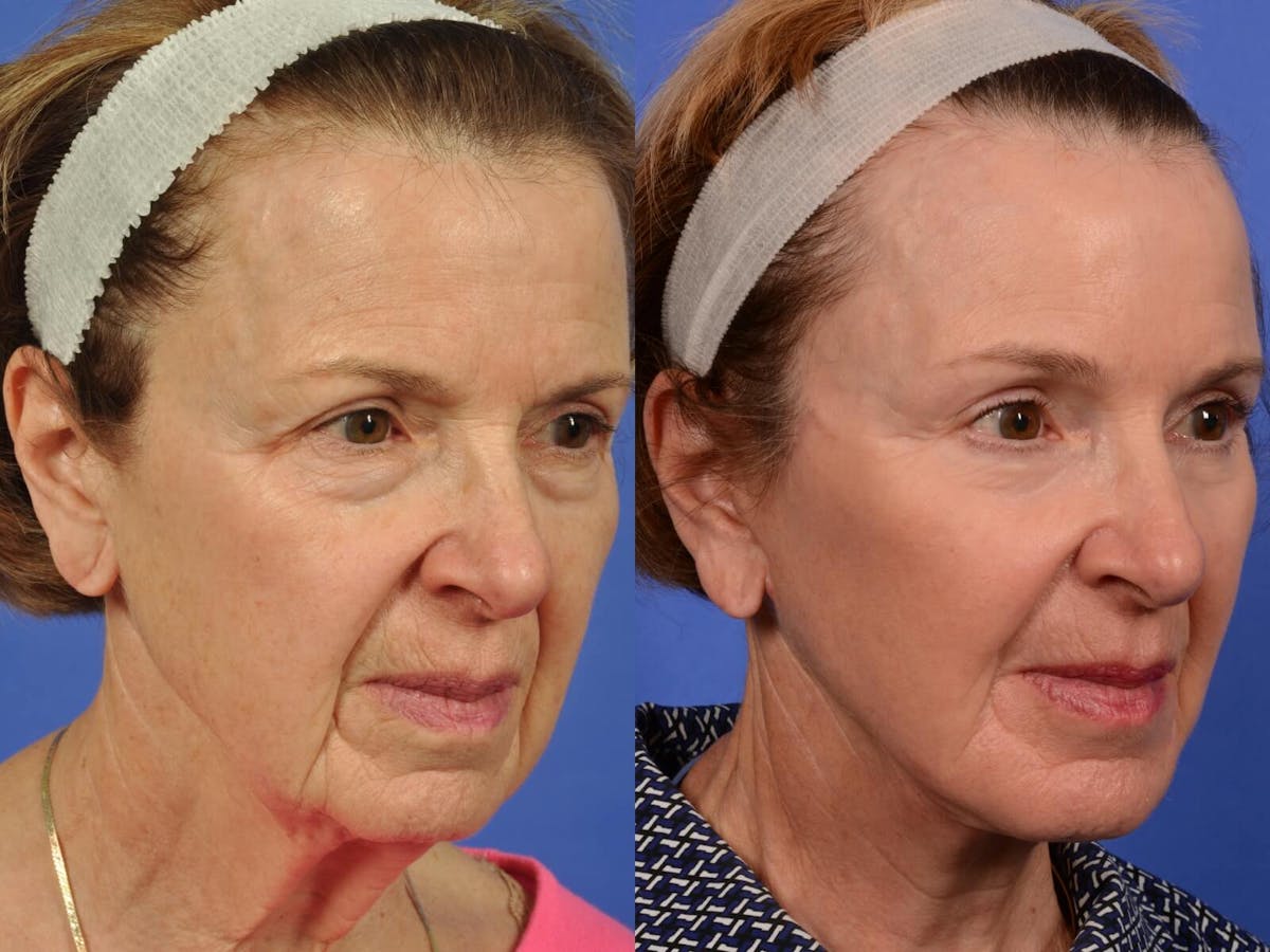 Neck Lift Before & After Gallery - Patient 486034 - Image 3