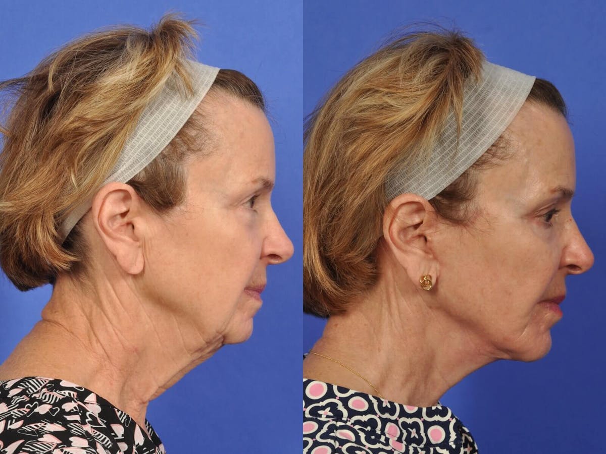 Neck Lift Before & After Gallery - Patient 486034 - Image 4