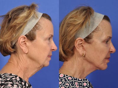Neck Lift Before & After Gallery - Patient 486034 - Image 4