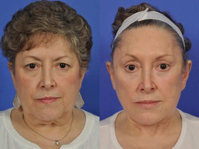 Neck Lift Before & After Gallery - Patient 411334 - Image 1