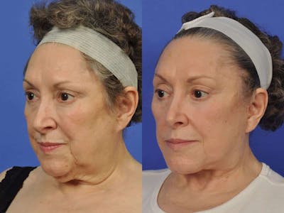 Neck Lift Before & After Gallery - Patient 411334 - Image 2