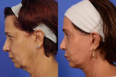 Neck Lift Before & After Gallery - Patient 758781 - Image 5
