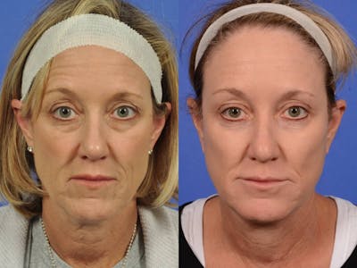 Neck Lift Before & After Gallery - Patient 206442 - Image 1