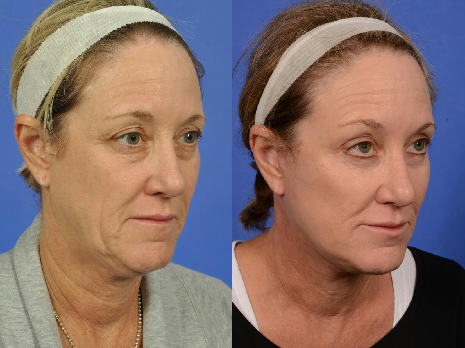 Neck Lift Before & After Gallery - Patient 206442 - Image 2