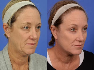 Neck Lift Before & After Gallery - Patient 206442 - Image 2