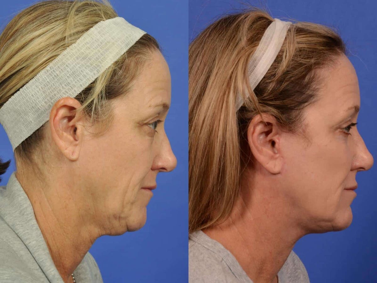 Neck Lift Before & After Gallery - Patient 206442 - Image 5