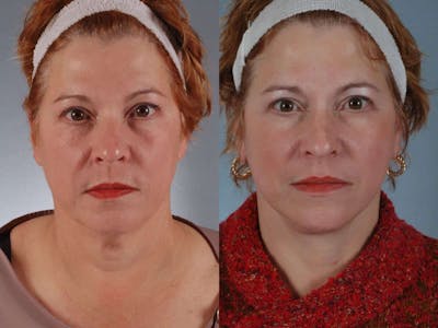 Neck Lift Before & After Gallery - Patient 252992 - Image 1