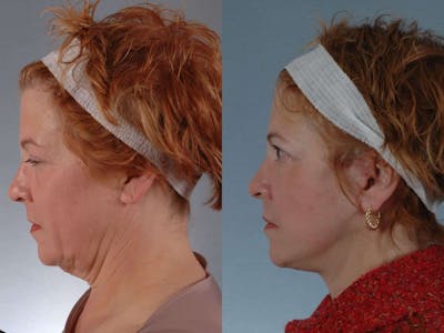 Neck Lift Before & After Gallery - Patient 252992 - Image 2
