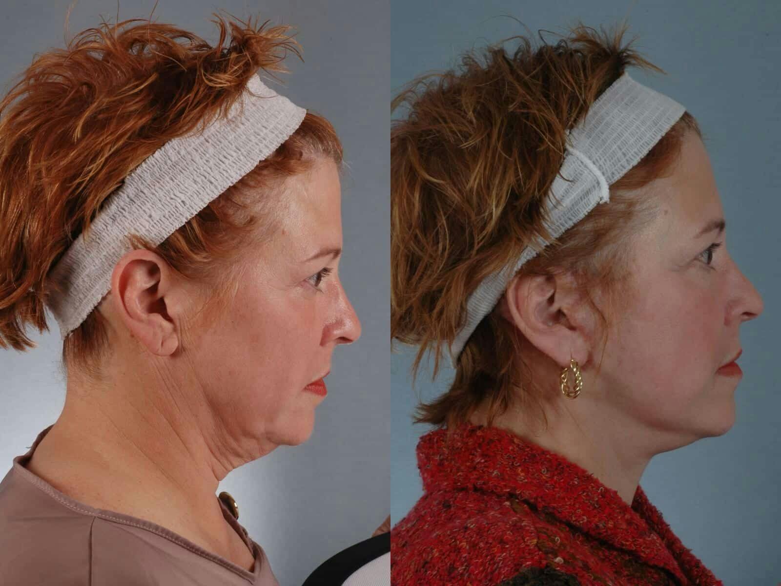 Neck Lift Before & After Gallery - Patient 252992 - Image 3