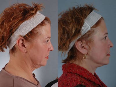 Neck Lift Before & After Gallery - Patient 252992 - Image 3