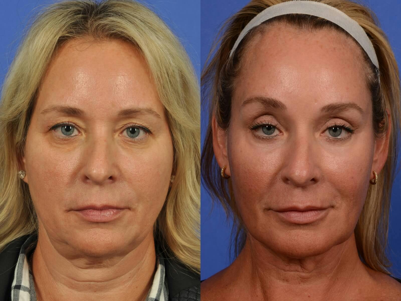 Synergy Lift Before & After Gallery - Patient 273472 - Image 1