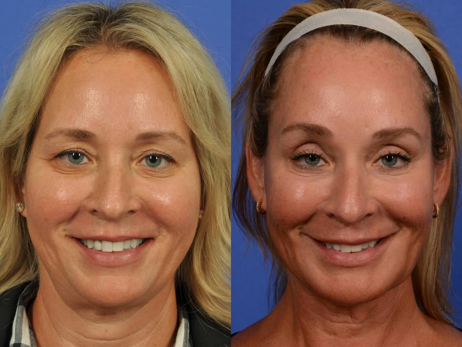 Synergy Lift Before & After Gallery - Patient 273472 - Image 2