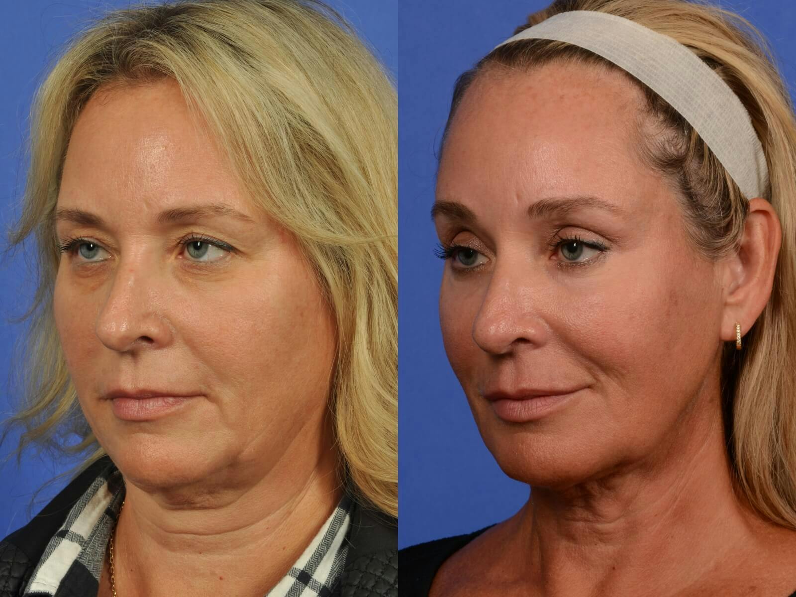 Synergy Lift Before & After Gallery - Patient 273472 - Image 3