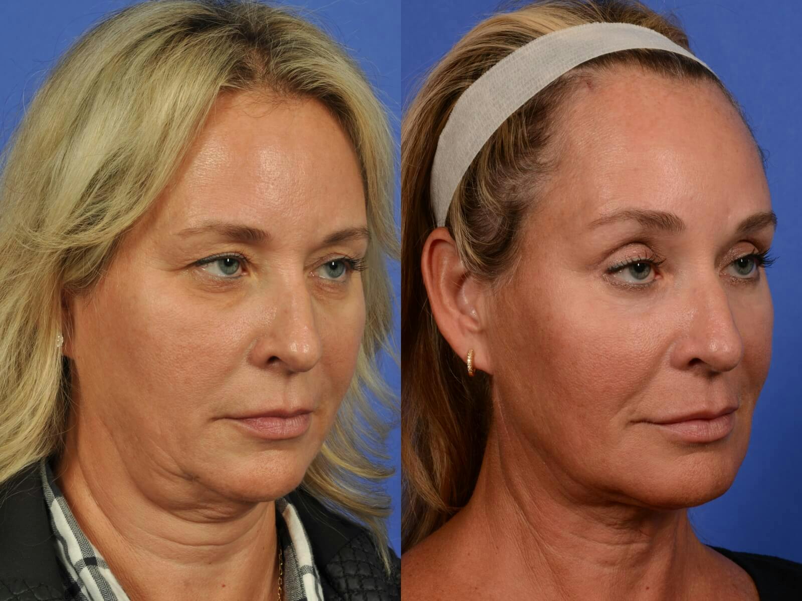 Synergy Lift Before & After Gallery - Patient 273472 - Image 4