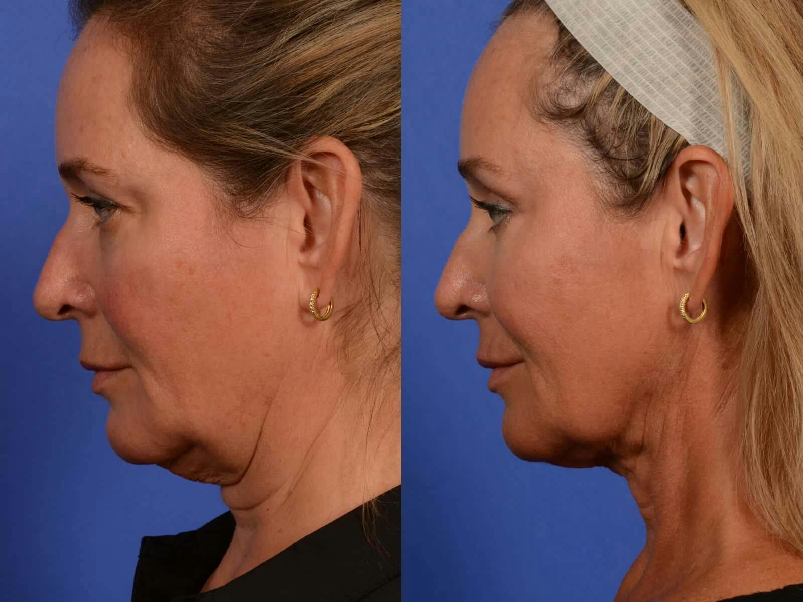 Synergy Lift Before & After Gallery - Patient 273472 - Image 5