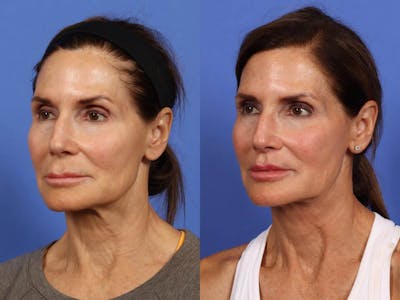 Synergy Lift Before & After Gallery - Patient 281555 - Image 4