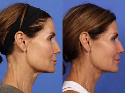 Synergy Lift Before & After Gallery - Patient 281555 - Image 5