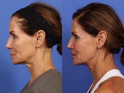 Synergy Lift Before & After Gallery - Patient 281555 - Image 6