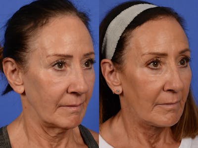 Synergy Lift Before & After Gallery - Patient 271478 - Image 2