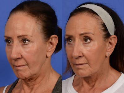 Synergy Lift Before & After Gallery - Patient 271478 - Image 3
