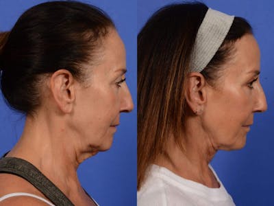Synergy Lift Before & After Gallery - Patient 271478 - Image 4