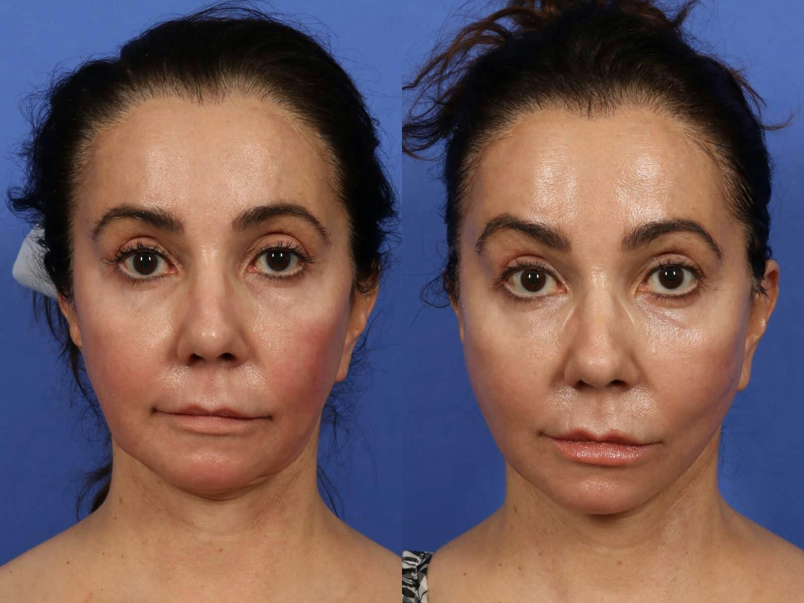 Synergy Lift Before & After Gallery - Patient 383733 - Image 1
