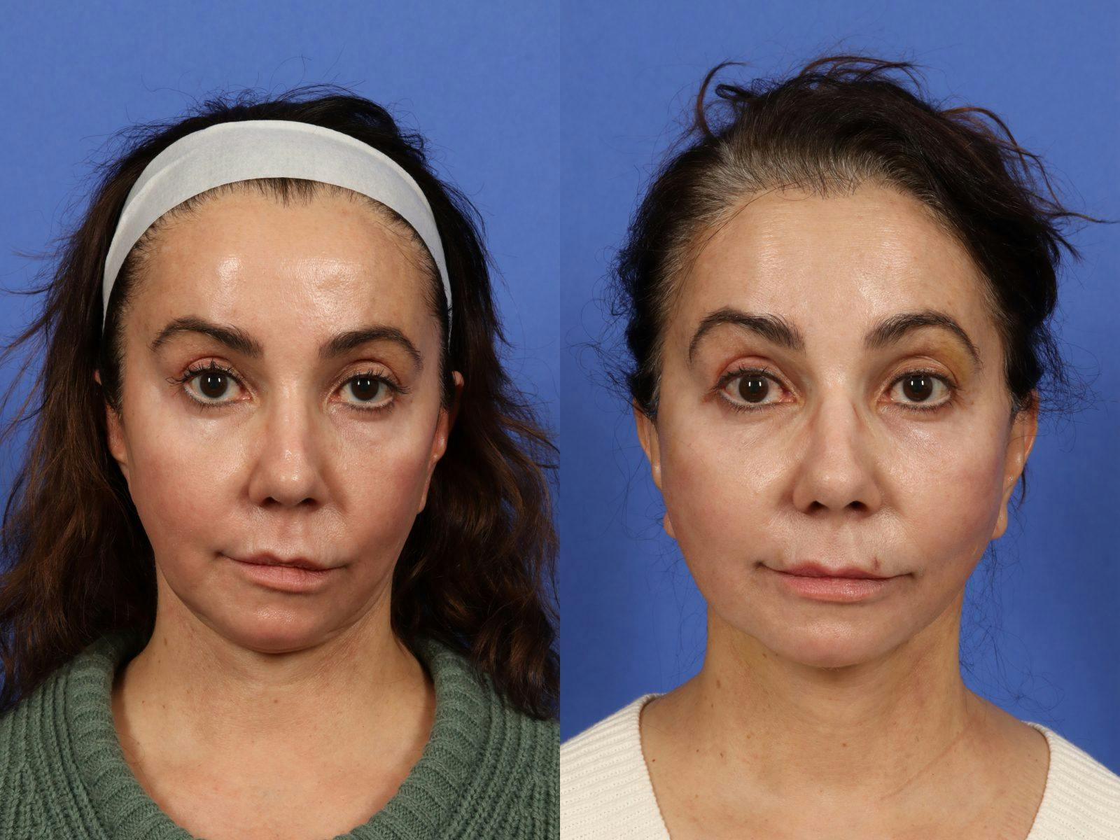 Synergy Lift Before & After Gallery - Patient 383733 - Image 2