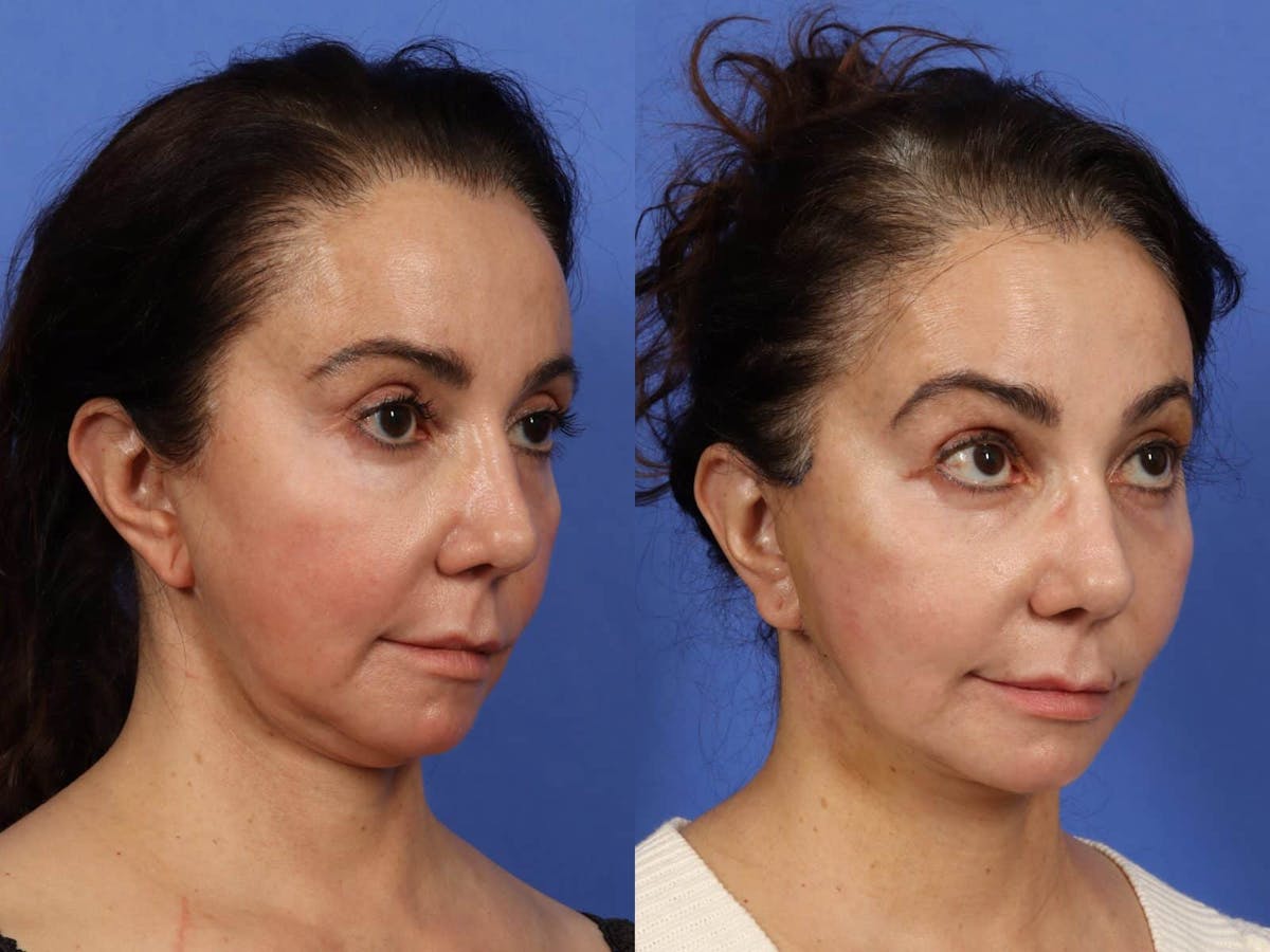 Synergy Lift Before & After Gallery - Patient 383733 - Image 3