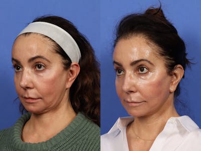 Synergy Lift Before & After Gallery - Patient 383733 - Image 4
