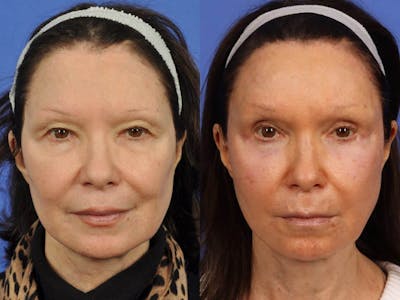 Synergy Lift Before & After Gallery - Patient 397070 - Image 1