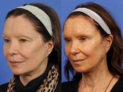 Synergy Lift Before & After Gallery - Patient 397070 - Image 2