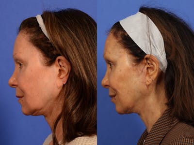 Synergy Lift Before & After Gallery - Patient 397070 - Image 4