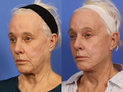 Synergy Lift Before & After Gallery - Patient 104332 - Image 2