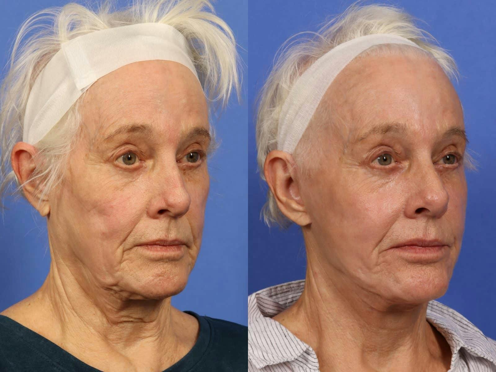 Synergy Lift Before & After Gallery - Patient 104332 - Image 3