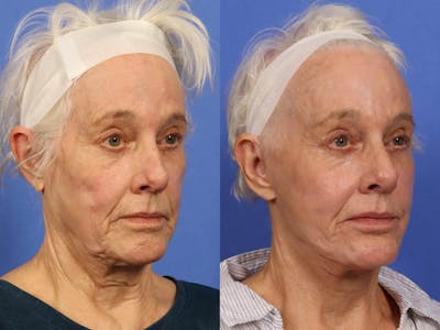 Synergy Lift Before & After Gallery - Patient 104332 - Image 3