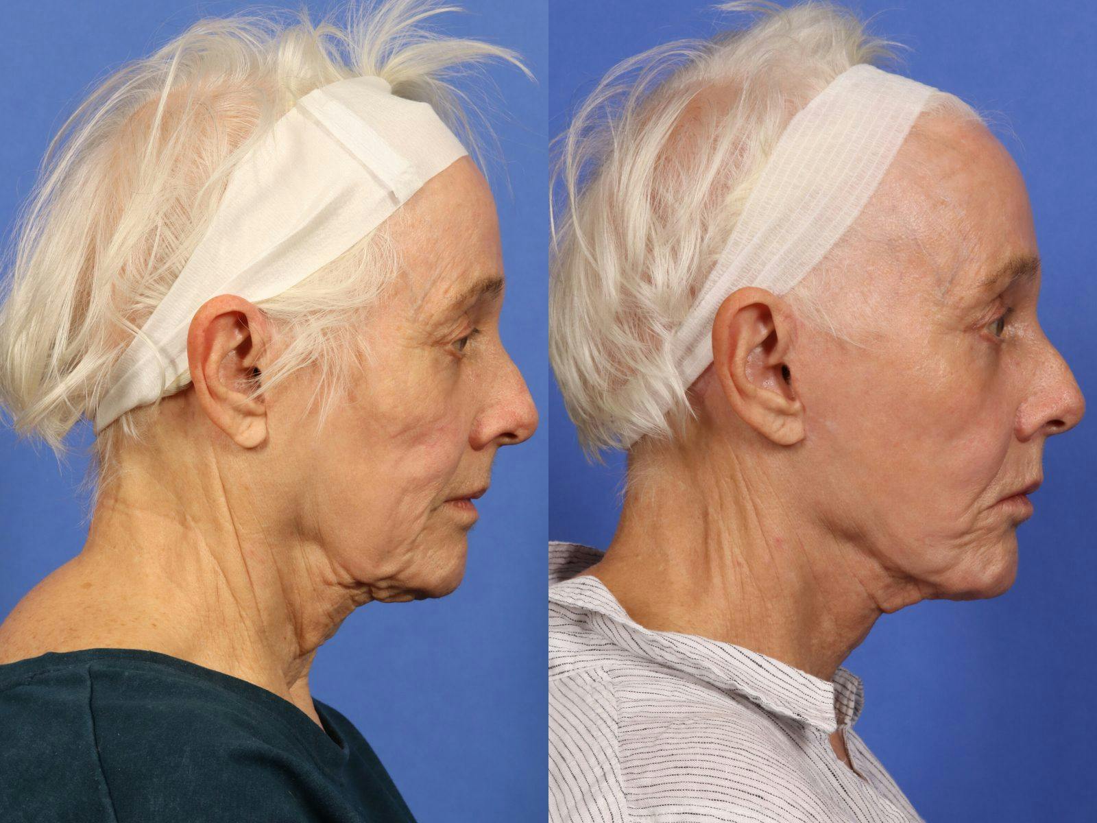 Synergy Lift Before & After Gallery - Patient 104332 - Image 5