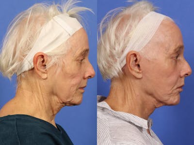 Synergy Lift Before & After Gallery - Patient 104332 - Image 5