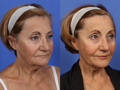Synergy Lift Before & After Gallery - Patient 254907 - Image 2