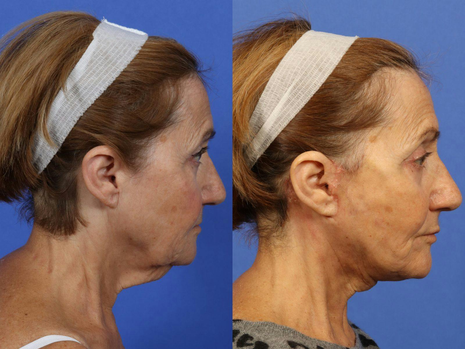 Synergy Lift Before & After Gallery - Patient 254907 - Image 4