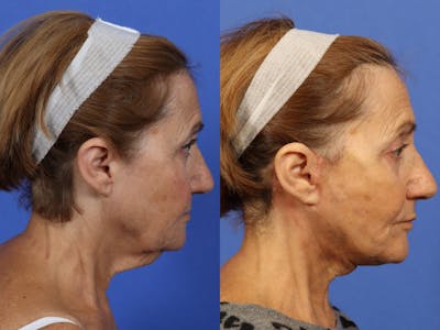 Synergy Lift Before & After Gallery - Patient 254907 - Image 4