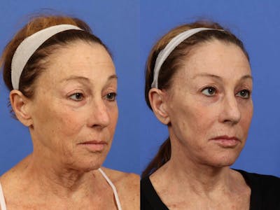 Synergy Lift Before & After Gallery - Patient 290938 - Image 1