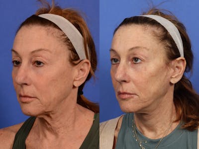 Synergy Lift Before & After Gallery - Patient 290938 - Image 2