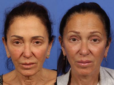 Synergy Lift Before & After Gallery - Patient 321082 - Image 1