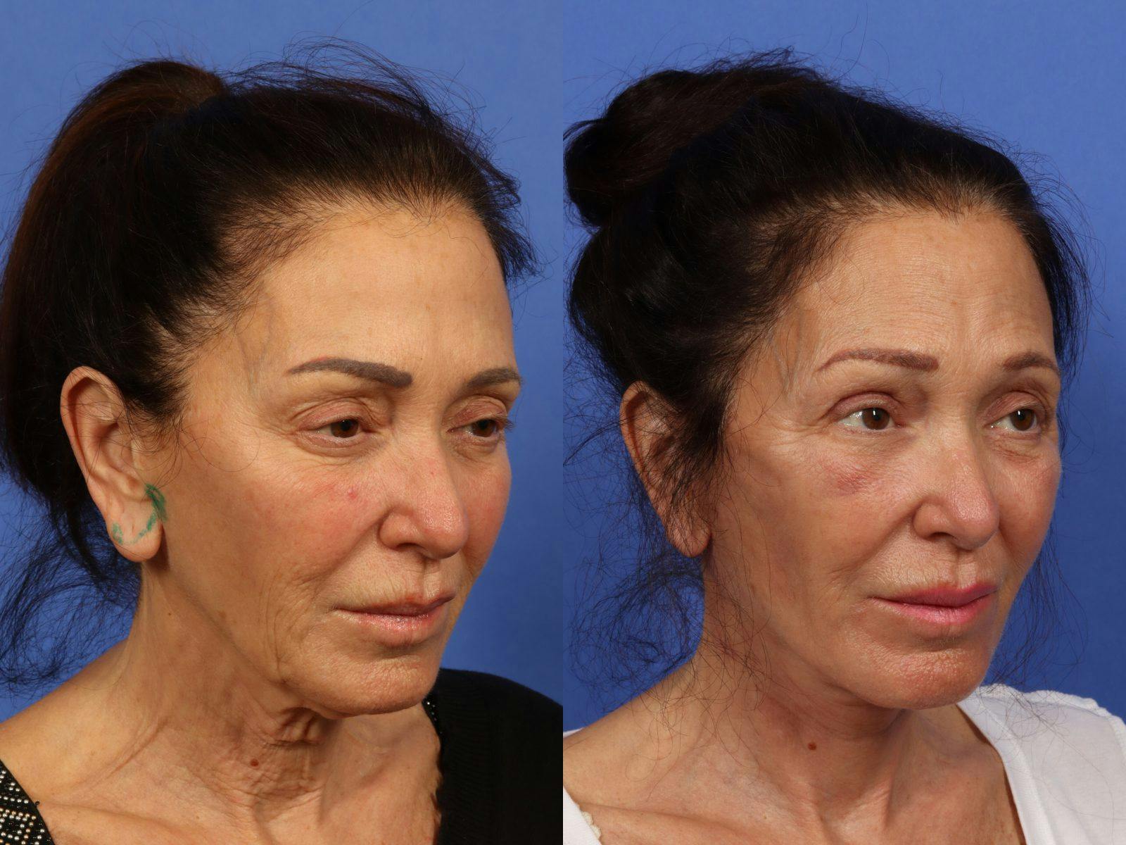 Synergy Lift Before & After Gallery - Patient 321082 - Image 2