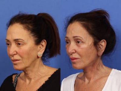 Synergy Lift Before & After Gallery - Patient 321082 - Image 3