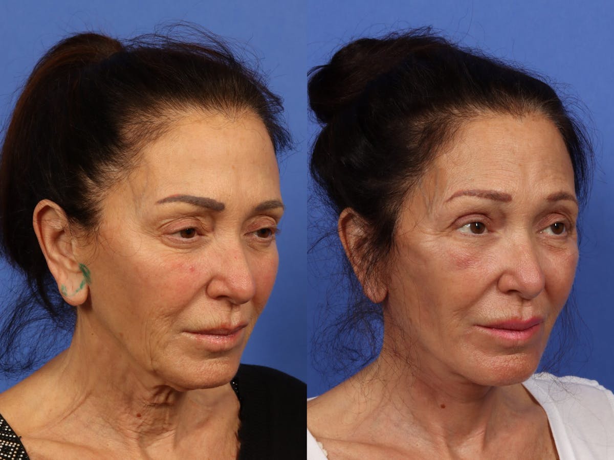 Synergy Lift Before & After Gallery - Patient 321082 - Image 4
