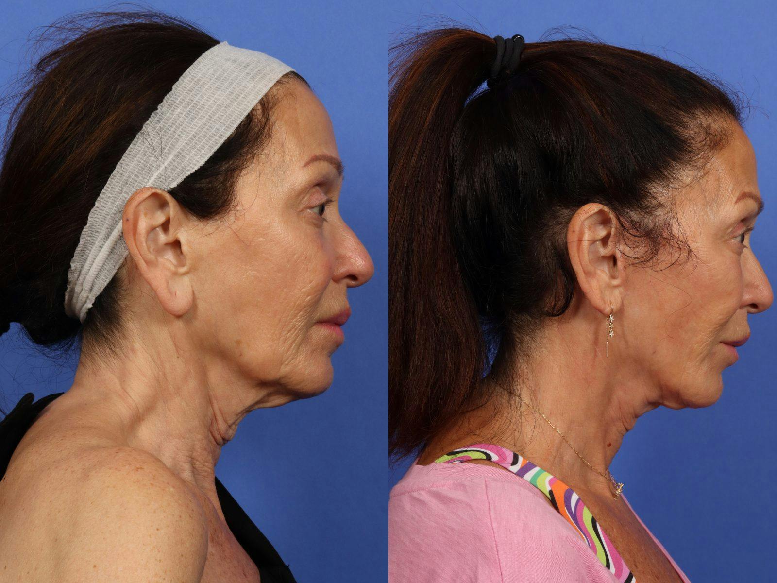 Synergy Lift Before & After Gallery - Patient 321082 - Image 5