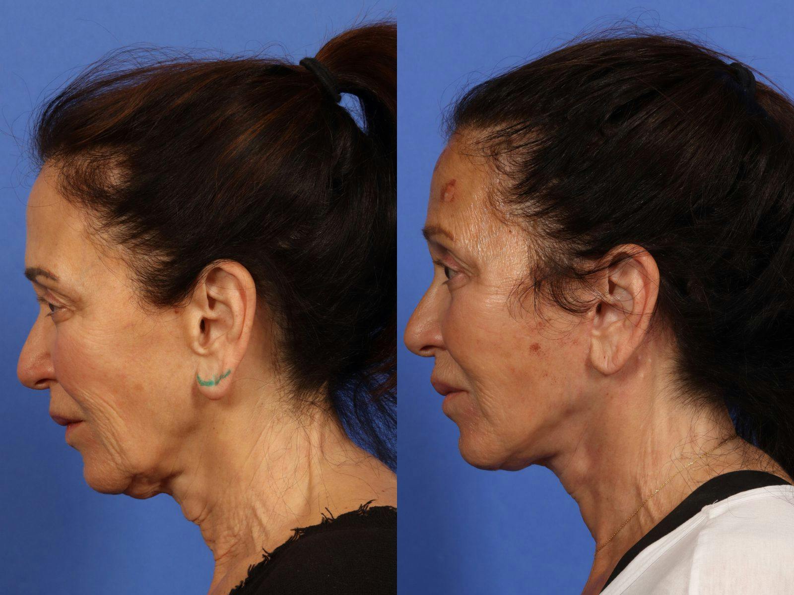 Synergy Lift Before & After Gallery - Patient 321082 - Image 6