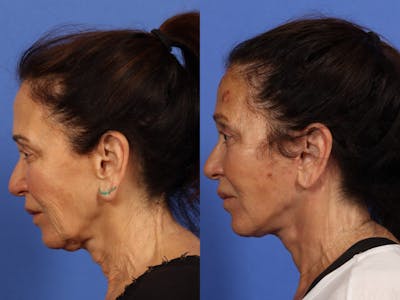 Synergy Lift Before & After Gallery - Patient 321082 - Image 6