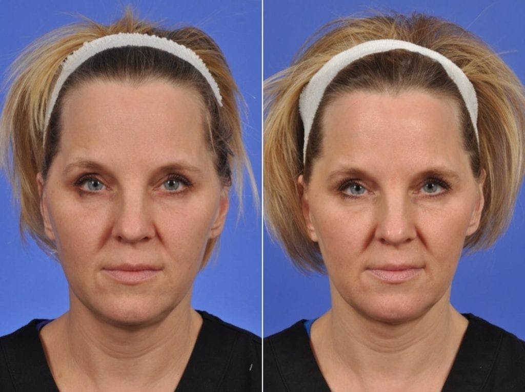 ThermiTight Before & After Gallery - Patient 299911 - Image 1